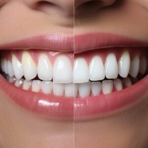 Teeth Whitening Process In Penang